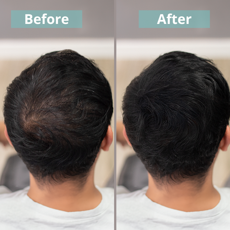 Pack adiós calvicie