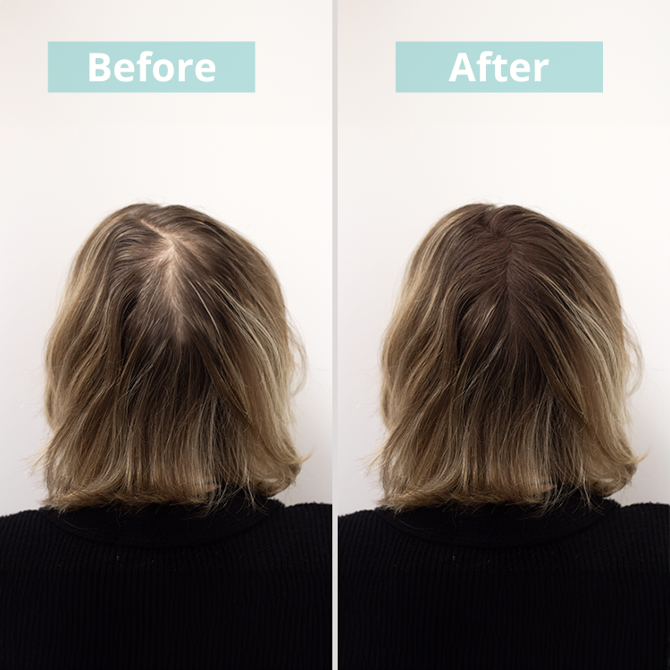 Pack adiós calvicie