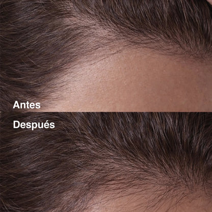 Tratamiento láser capilar domiciliario